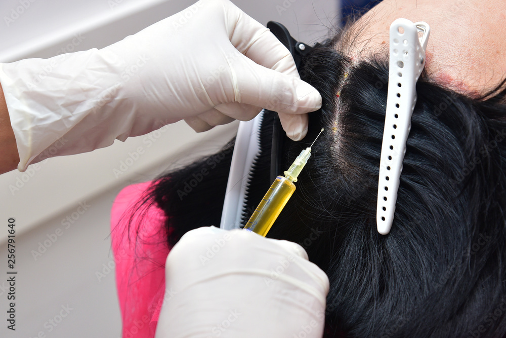 Fototapeta premium Łuszczyca. Owłosiona część głowy. Wstrzyknięcie osocza. Leczenie ludzkiej krwi zabolivanie osocza.