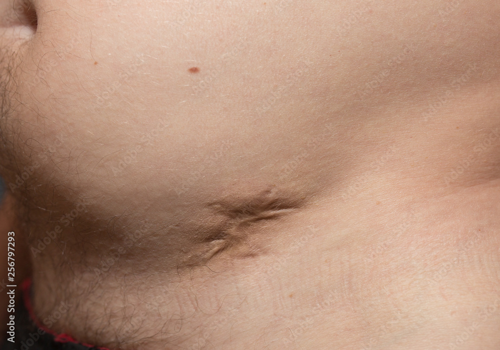 Ugly bad scar on the man's fat belly after the appendicitis surgery. Old keloid scar on the stomach. Medical treatment disease photo. Ugly bad scar on the man's fat belly after the appendicitis surgery. Old keloid scar on the stomach. Medical treatment disease photo.
