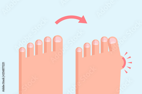 Healthy and deformed feet