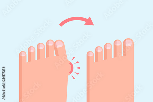 Deformed and healthy feet
