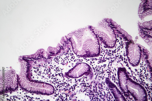 Histopathology of chronic superficial gastritis, light micrograph, photo under microscope photo