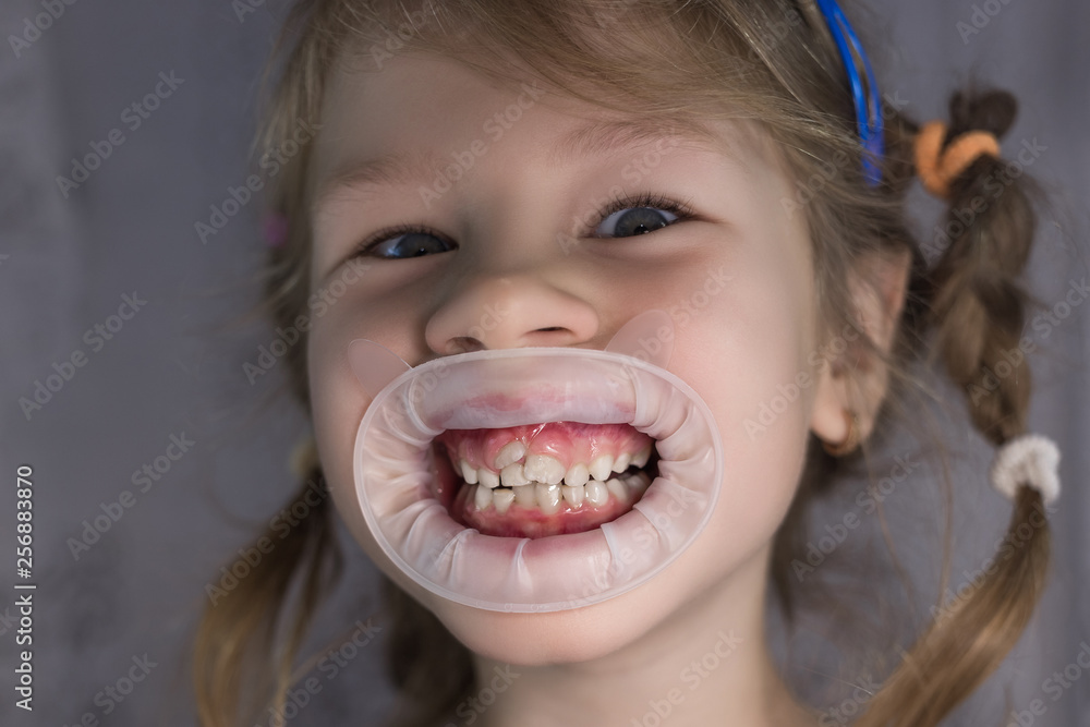 Adult permanent teeth coming in front of the child's baby teeth: shark teeth. Adult permanent teeth coming in front of the child's baby teeth: shark teeth.