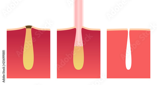 laser cure acne