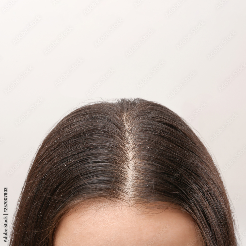 Woman with dandruff in her dark hair on light background, closeup view. Space for text Woman with dandruff in her dark hair on light background, closeup view. Space for text