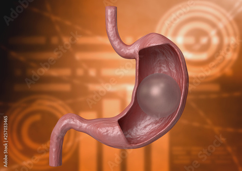 Canvastavla Balloon gastric