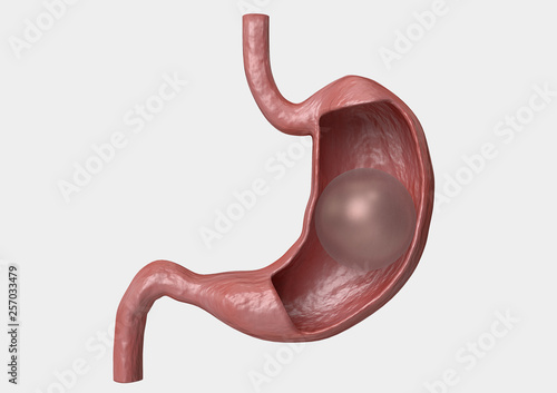 Canvastavla Balloon gastric