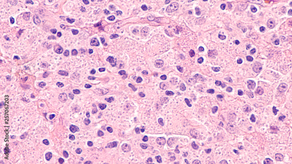 Histoplasma Capsulatum