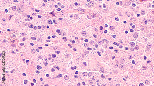 Microscopic image of disseminated histoplasmosis, a type of fungal infection caused by the fungus Histoplasma capsulatum,  The yeast forms appear as small dots within the cytoplasm of macrophages.  photo