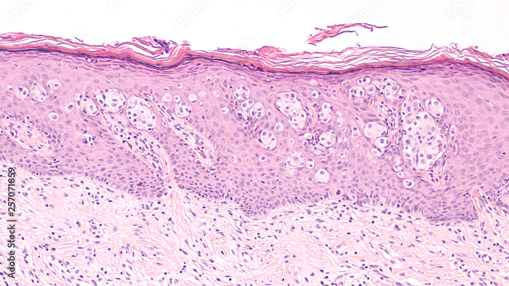 Breast Cancer Awarness: Paget's Disease of the breast (nipple) is usually associated with ductal carcinoma in situ (DCIS). Malignant cells extent into epidermis of skin, giving an eczema-like rash. - obrazy, fototapety, plakaty 