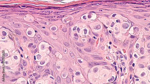 Breast Cancer Awarness: Paget's Disease of the breast (nipple) is usually associated with ductal carcinoma in situ (DCIS). Malignant cells extent into epidermis of skin, giving an eczema-like rash.