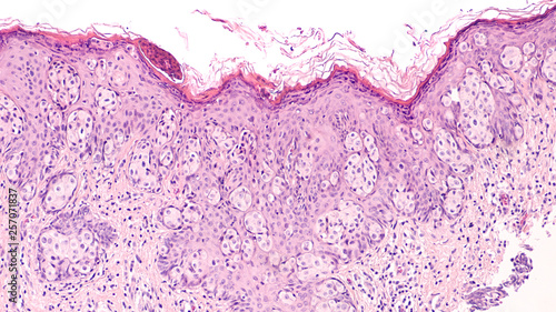 Breast Cancer Awarness: Paget's Disease of the breast (nipple) is usually associated with ductal carcinoma in situ (DCIS). Malignant cells extent into epidermis of skin, giving an eczema-like rash. photo