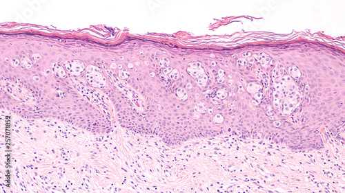 Breast Cancer Awarness: Paget's Disease of the breast (nipple) is usually associated with ductal carcinoma in situ (DCIS). Malignant cells extent into epidermis of skin, giving an eczema-like rash. photo