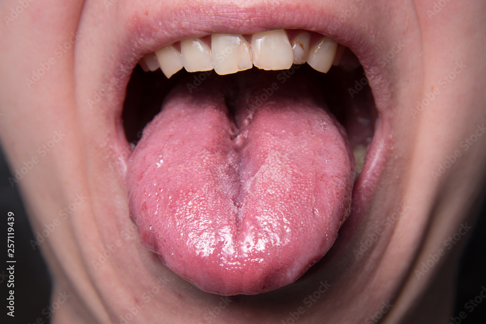 Obraz premium Male shows overgrowth candidiasis on his tongue