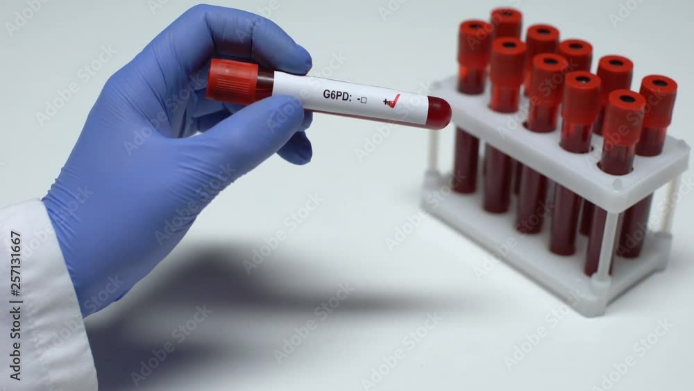 Positive G6PD test, doctor showing blood sample, lab research, health