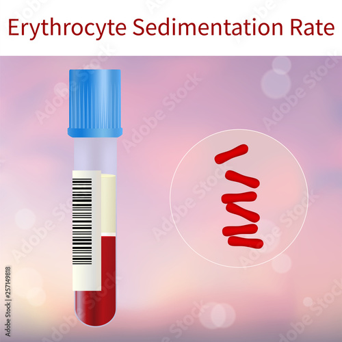 Blood test. Erythrocyte sedimentation rate, tube. Vector medical illustration. Pink abstract background.