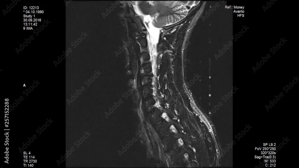 MRI scans, lumbar spine closeup Stock Video | Adobe Stock