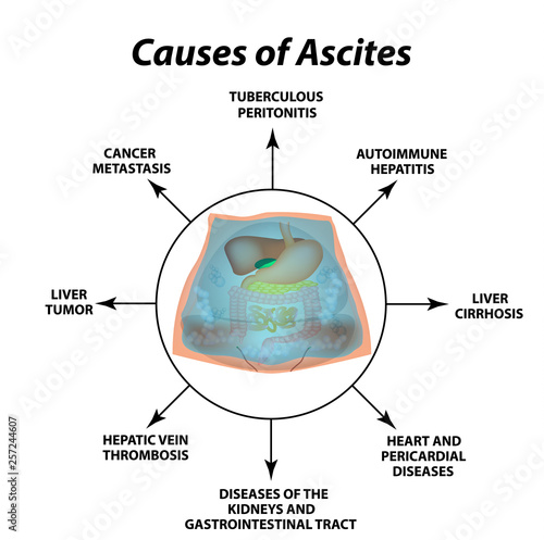 Ascites Free fluid in the abdominal cavity. Infographics. Vector illustration on isolated background.