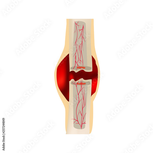 1 Stage Of Healing Bone Fracture. Formation of callus. Hematoma. The bone fracture. Infographics. Vector illustration on isolated background. photo