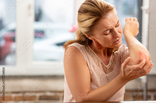 Bild auf Leinwand Mature woman with strong allergy noticing rash on elbow