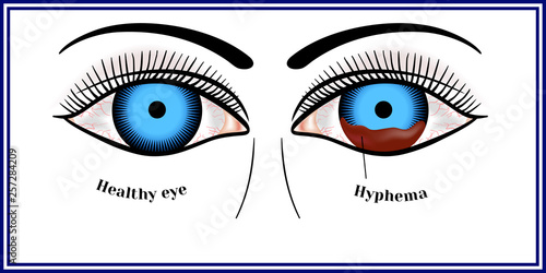 Hyphema