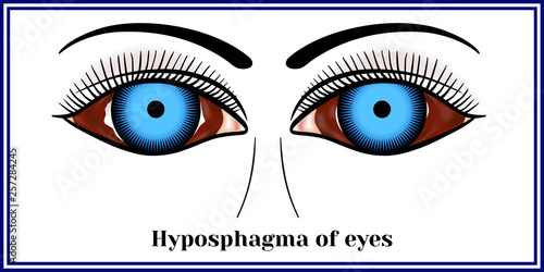 Hyposphagma of eyes