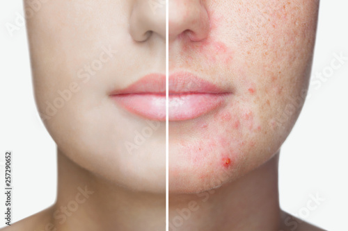 A young girl with a problem skin. Photo before and after treatment for acne. photo
