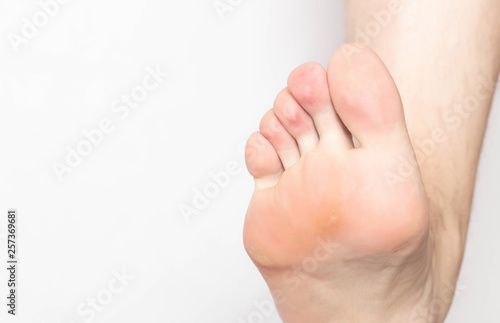 Problem skin with calluses and corns on the sole of the human foot, dry and rough skin, inflammation and pain, foot, close-up, copy space, dermatology
