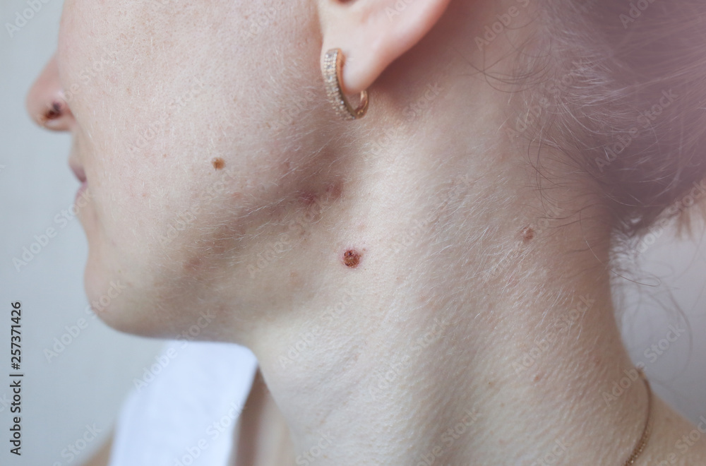 Scars and wounds on the neck after acne. Removal of birthmarks and nevus. Problems with skin. Scars and wounds on the neck after acne. Removal of birthmarks and nevus. Problems with skin.