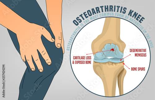 Osteoarthritis Knee Poster photo