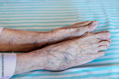 Side view of elder human feet with purple veins © Ipek Morel
