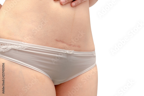 Closeup of woman showing on her belly scar from a cesarean section