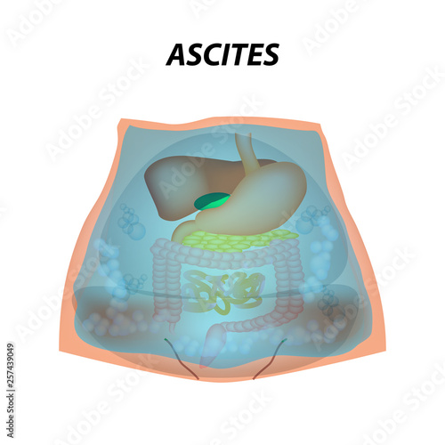 Ascites Free fluid in the abdominal cavity. Infographics. Vector illustration on isolated background.