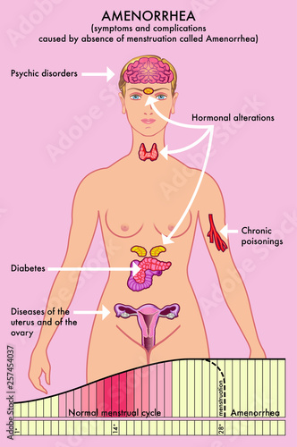 Medical diagram of symptoms and complications caused by absence of menstruation called Amenorrhea.