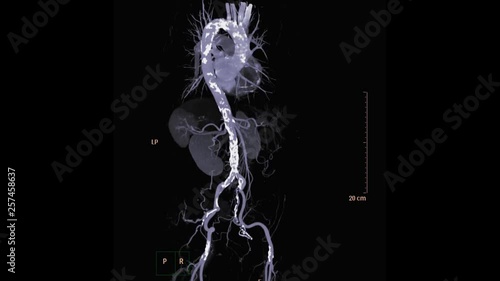 CTA abdominal aorta 3D  MIP technique turn around on the screen 3D production from CT scanner. medical technology concept. photo