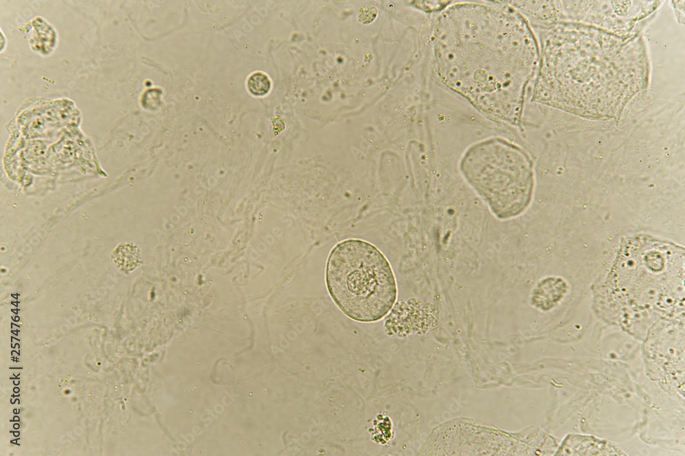 Epithelial Cells With Bacteria In Patient Urine Urinary Tract 