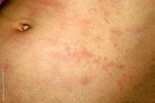 Pink lichen on the skin of the abdomen. Psoriasis, dermatitis, eczema, urticaria, allergies. photo
