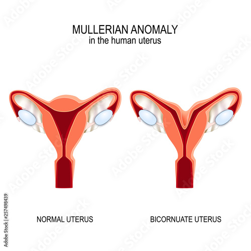 Normal womb and Bicornuate uterus.