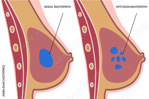 Diffusion and nodal mastopathy.Benign tumor.Mammary gland.