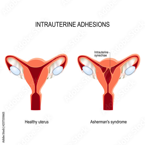 uterine adhesions. scar tissue. Asherman's syndrome