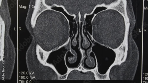 Doctor examines Computed tomography of human Paranasal Sinuses