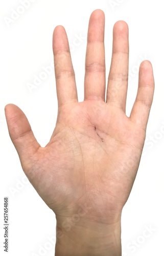 A lesion in palm is caused by sharp weapon graze and making scar soon. A hand was isolated on white background.