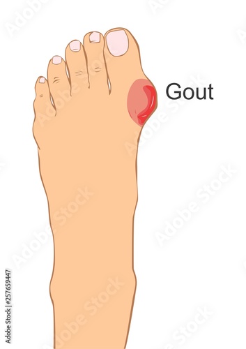 Painful and Inflammed Gout