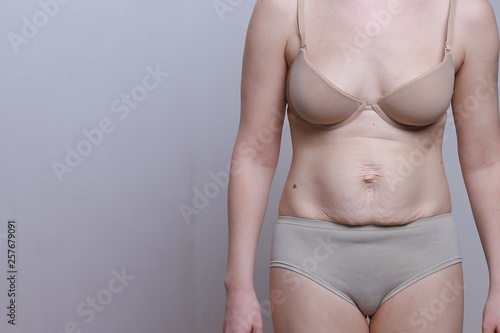 A woman with a figure after giving birth. Stretch marks on the belly. Front view