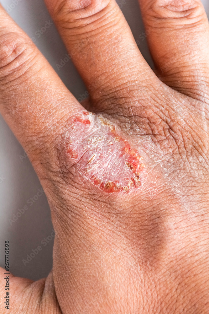 Fototapeta premium Hand With Atopic Dermatitis Eczema Psoriasis Vulgaris