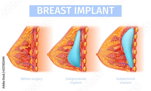 Woman's Breast Implant Insertion Medical Banner