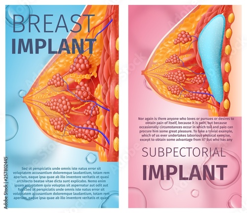 Breast Implant Anatomical Vertical Banner Set