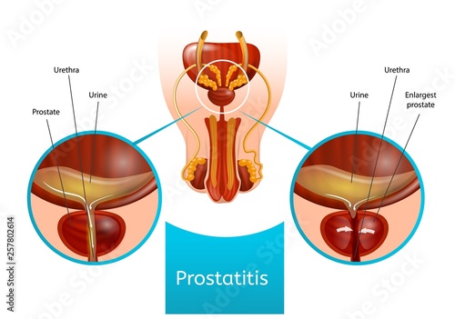 Prostatitis Scheme with Male Reproductive System