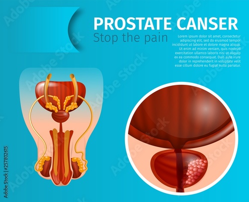 Cancerous Tumor Cells in Prostate Gland Banner