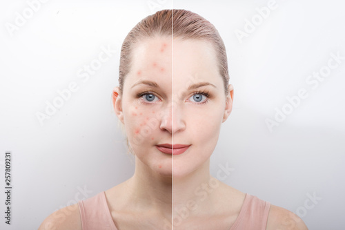 the girl's face before and after. difference after cosmetic procedures. Treatment of skin diseases. causes of acne. cleansing.
