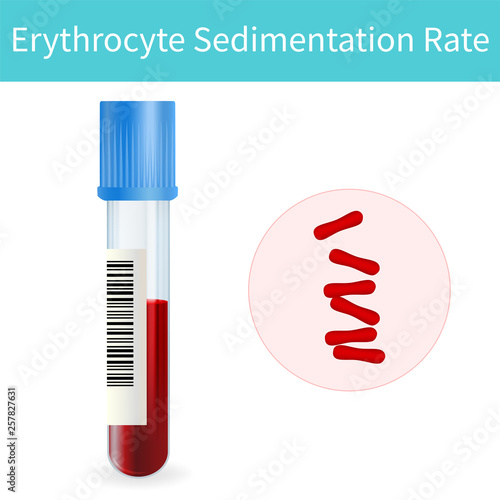 Blood test. Erythrocyte sedimentation rate, tube. Vector medical illustration. Pink abstract background.